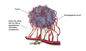 Scheme representing neoangiogenic vessels connecting a tumor mass to a main vessel